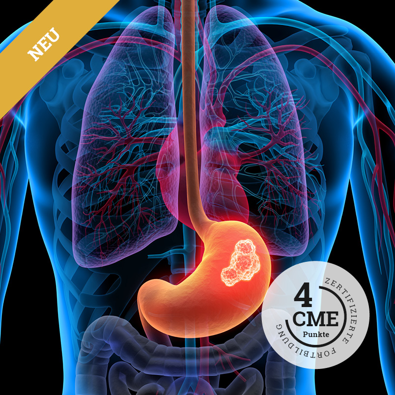 CME-Fortbildung zur aktuellen Diagnostik und Behandlung Gastrointestinaler Stromatumoren (GIST)