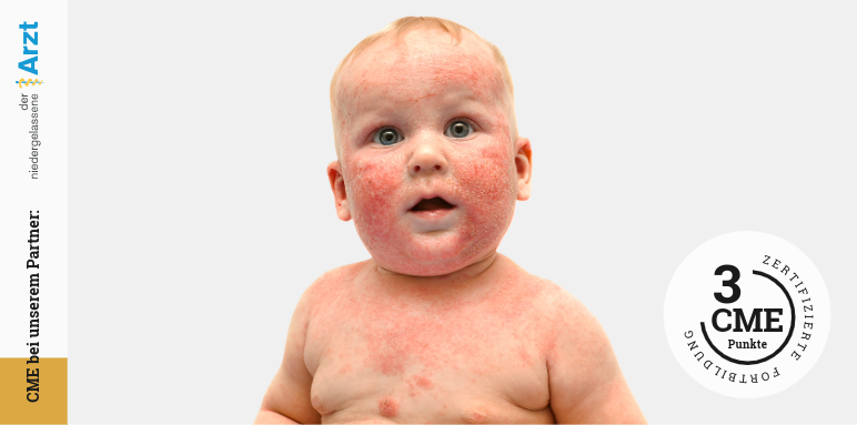 CME-Fortbildung zu Psoriasis und Mikrobiom