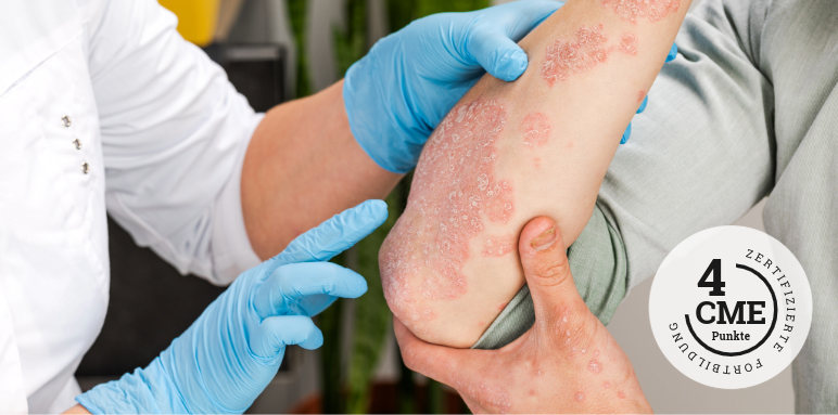 CME-Fortbildung zu Shared Decision Making in der Therapie des Mammakarzinoms