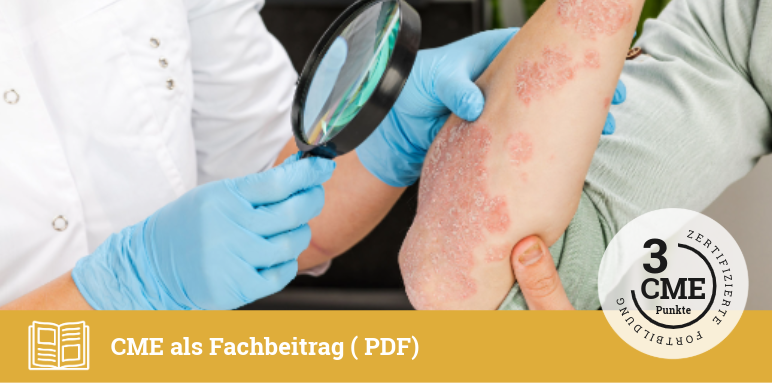 Psoriasis-Therapie
